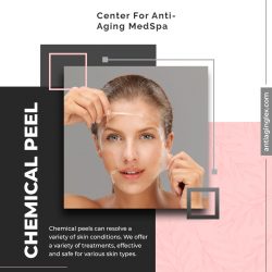 Online best Chemical acne peel treatment at Anti-Aging Medical Spa