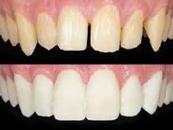 Affordable Cosmetic Dentistry Procedures