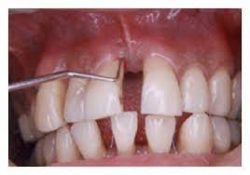 periodontitis Treatment