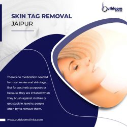 Know about the skin tag removal Jaipur at Outbloom Clinics