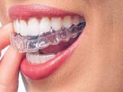 What Are The Best Braces Colors?