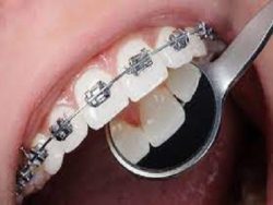 Orthodontist Braces Near Me