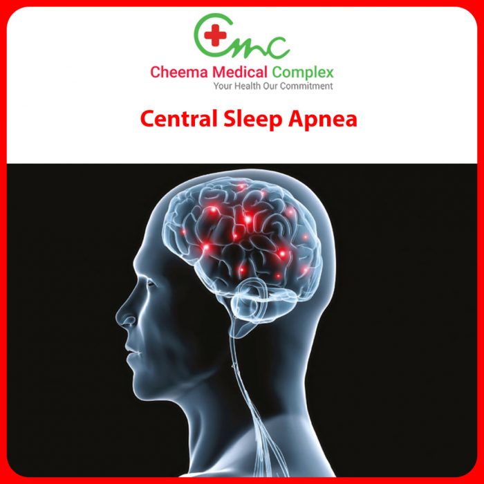Central Sleep Apnea Symptoms and Treatments