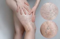 what causes spider veins
