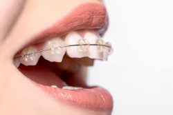 orthodontic braces cost