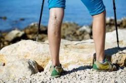 What is the Best Vein Treatment for Spider and Varicose Veins?