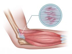 What is Tendinitis – Causes, Symptoms and Medical Treatment
