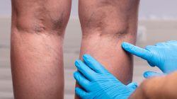 Harvard Trained Vein Doctor | The Vein Center in NJ Answers Vein Disease FAQs