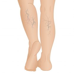 Harvard Trained Vein Doctor | The Vein Center in LI Answers FAQs
