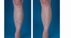 Nationally Recognized Vein Doctor | The Vein Center in Texas Answers FAQs