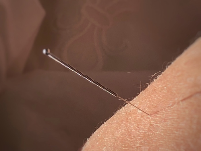 What is Acupuncture Therapy?