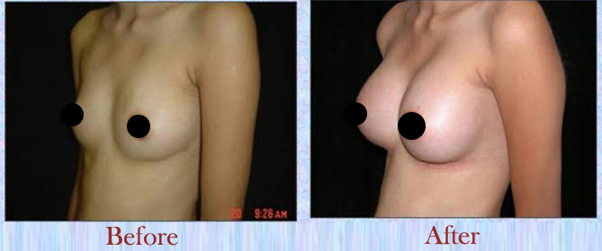 Best Breast Implant Surgery Cost in Delhi | Dr. Vivek Kumar