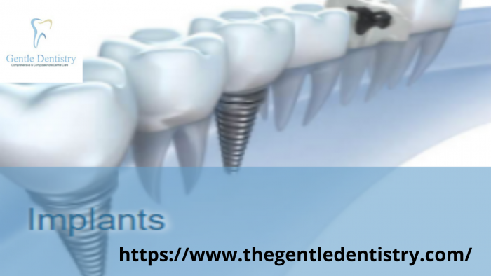 Dental Implants Carmel Valley San Diego