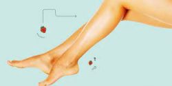Looking for varicose vein treatment in Houston?