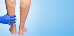 Your varicose veins and spider veins could recur 