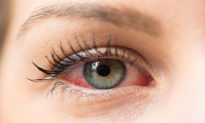 Why does eyelash glue cause irritation?