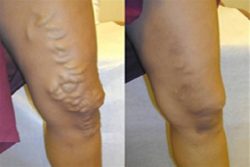 Harvard Trained Vein Doctor | Introducing the Spider Vein and Varicose Vein Center in New Jersey ...