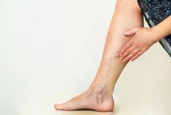Harvard Trained Vein Doctor | Treatment for Varicose and Spider veins during pregnancy