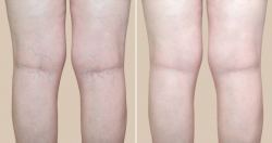 Harvard Trained Vein Doctor | Things to know before and after spider vein removal