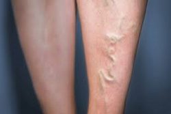 Harvard Trained Vein Doctor | How Can I Find the Best Varicose Vein Clinic Near Me? | Vein Treat ...