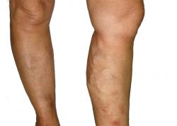 Top characteristics of a leading Vein Specialist | Nationally Recognized Vein Doctor | Vein Trea ...