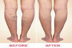 The Best Vein Clinic for Expert Vein Care | Harvard Trained Doctors | Vein Treatment Clinic | Ve ...