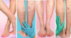 Top Spider Vein Treatments and their Pros and Cons | Vein Treatment Clinic | Harvard Trained Doc ...