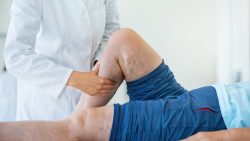 What are the best Spider and Varicose Vein Treatment Options? | A guide by our Harvard Trained V ...