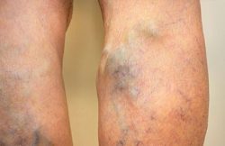 Harvard Trained Vein Doctors | What Causes Swelling in Feet? | VIP Medical Group