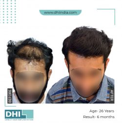 DHI India – Hair Transplant in Chandigarh