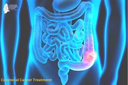 Colorectal Cancer Treatment Clinic in Mumbai