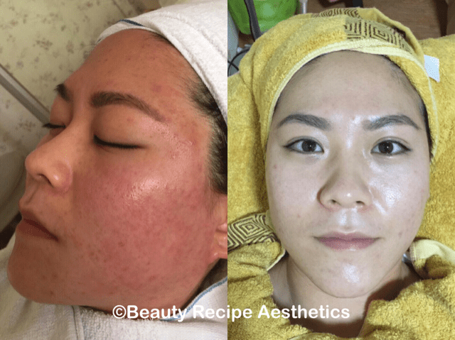 Deep Cleansing Facial With Advance Technique