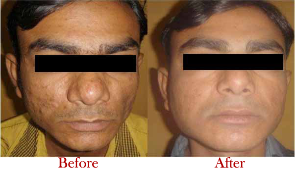Best Laser Treatment for Acne Scars at Reasonable Cost in Delhi | Dr. Hema Pant
