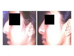 Best Nose Surgery at Reasonable cost in Delhi | Sculpt India