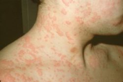 What is the most effective treatment for Urticaria?