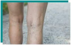 Harvard Trained Vein Doctors | Average Cost of Varicose Vein Treatment New Jersey | VIP Medical  ...