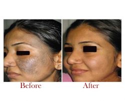Best Acne scar treatment in Delhi | Sculpt India