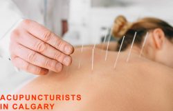 Best Acupuncture Calgary | Acupuncturists in Calgary