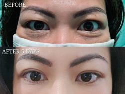 Want Natural Eyes Try Eye Bag Removal Treatment