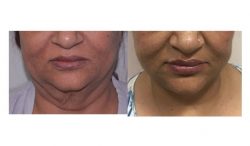 Best Facelift Surgery in Delhi | Dr. Vivek Kumar