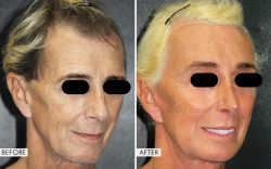 Procedures Involved in Facial Feminization Surgery