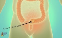 Find Best Colorectal Cancer Doctor in Mumbai