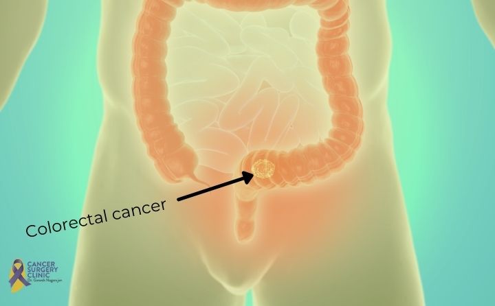 Find Best Colorectal Cancer Doctor in Mumbai