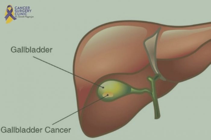 Gallbladder Cancer Treatment in Mumbai
