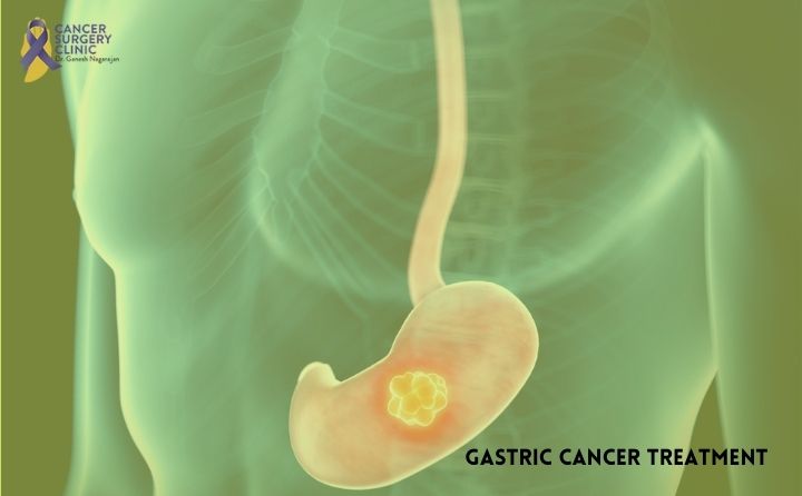 Top Gastric Cancer Treatment Clinic in Mumbai