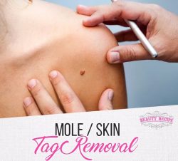 Looking For The Best Mole Removal Singapore?