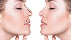 Rhinoplasty: Know All About Procedures & its Benefits