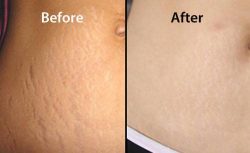 We Are Deciding To Help You With Stretch Mark Removal