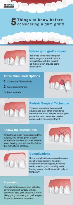5 Things to know Before Considering a Gum Graft!