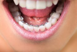 Why Visit A Professional Orthodontist For Teeth Bleaching?